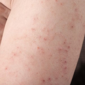 Dermatitis_Herpetiformis_rash1
